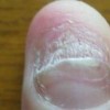 灰指甲的发生是由哪几个原因引起的
