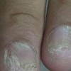 灰指甲病因 灰指甲甲癣的导致条件