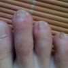 多种病因引发的灰指甲