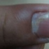 患灰指甲的有哪些要素