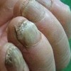 灰指甲常见因素有什么