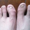 灰指甲常见致病因素