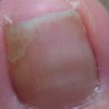 导致灰指甲的病因有什么