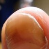 灰指甲初期病情的辨别措施