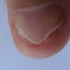常见导致灰指甲的病因有什么