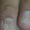 护理灰指甲有哪些措施