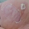 水泡型脚气治疗小偏方