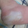 秋冬季节如何挣脱脚气的纠缠