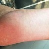 治疗脚气费用是多少钱