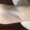 静脉排毒疗法治脚气患者釜底抽薪的治疗