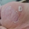 孕妇得脚气后应当怎么办