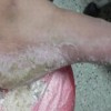 治疗脚气偏方