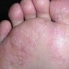 治愈脚气重燃期待