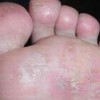 中药泡足是如何治疗脚气的
