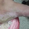 哪个医院治脚气