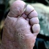 水泡型脚气的发病病因有什么