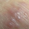 疥疮治疗时期注意什么