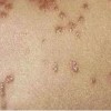 疥疮的临床症状和判断依据措施