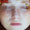 雀斑患者应该关注什么