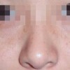 雀斑行不行遗传性的