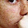 雀斑的预防有什么需求留心的