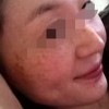 预防雀斑的小常识
