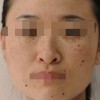 雀斑注意什么事情呢