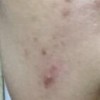 痤疮要如何避免较好