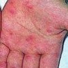 带状疱疹后遗症治疗