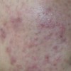 痤疮和青春痘是一种皮肤疾病吗
