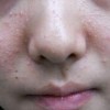 鼻子上长痘是哪些要素  (2)