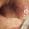 酒渣鼻的症状特点有哪些