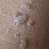 预防传染性软疣的特别注意都包含什么呢