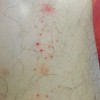过敏性紫癜该咋办判断