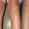 过敏性紫癜不要注射疫苗