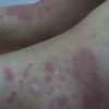 常见过敏性紫癜怎样的预防