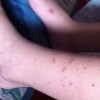 对过敏性紫癜要如何防范