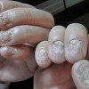 灰指甲的危害及防范