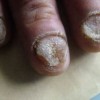 灰指甲的感染因素有哪什么