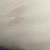 玫瑰糠疹有哪些作用