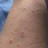玫瑰糠疹患者必要明了的知识