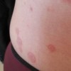 玫瑰糠疹的3种主要有什么症状
