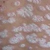 臀部牛皮癣银屑病要仔细确诊