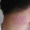 脓疱型牛皮癣的病因是啥