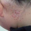 血管形成因素对牛皮癣是不是有影响