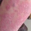 皮肤过敏的症状认知与自我检测