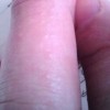 皮肤过敏的危害你清楚吗