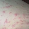 皮肤过敏病因都包含什么呢