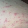 皮肤过敏有什么样的危害呢