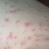 皮肤过敏的原因及治疗